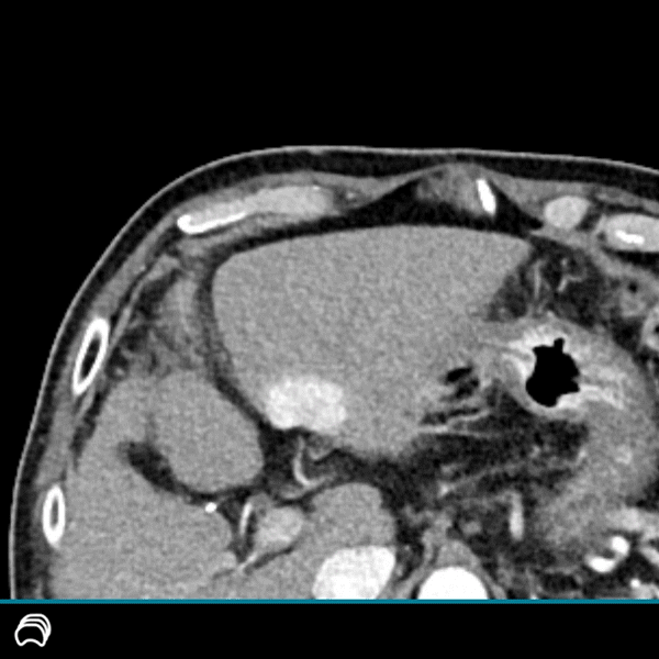 CT-Aufnahme des Abdomens, die eine Querschnittsansicht der Leber zeigt, mit einer dunklen, runden Läsion, die Gas oder Luft enthält und möglicherweise auf einen Abszess oder eine pathologische Höhle im Lebergewebe hindeutet.